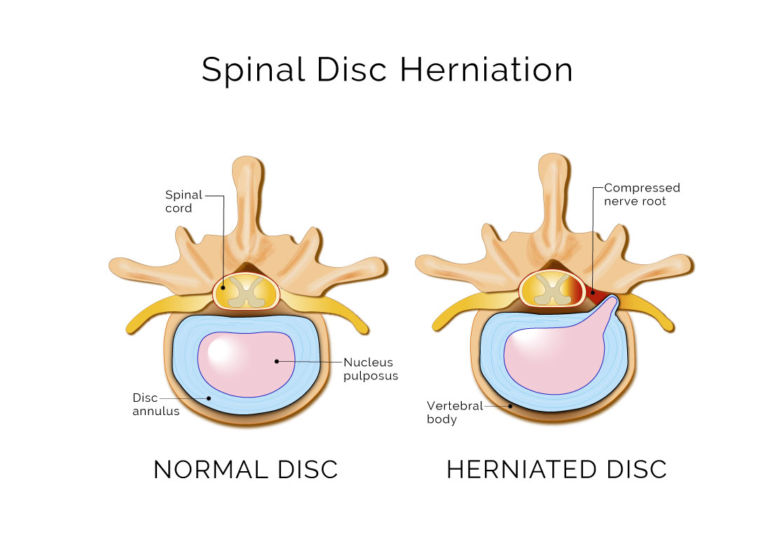 intervertebral disc herniation