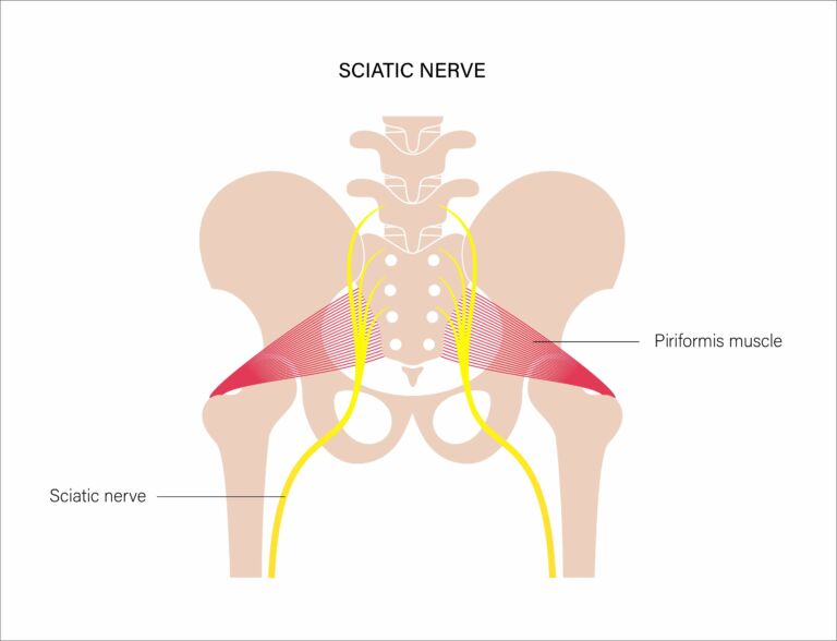 Sciatica vs. Sciatic Nerve Pain