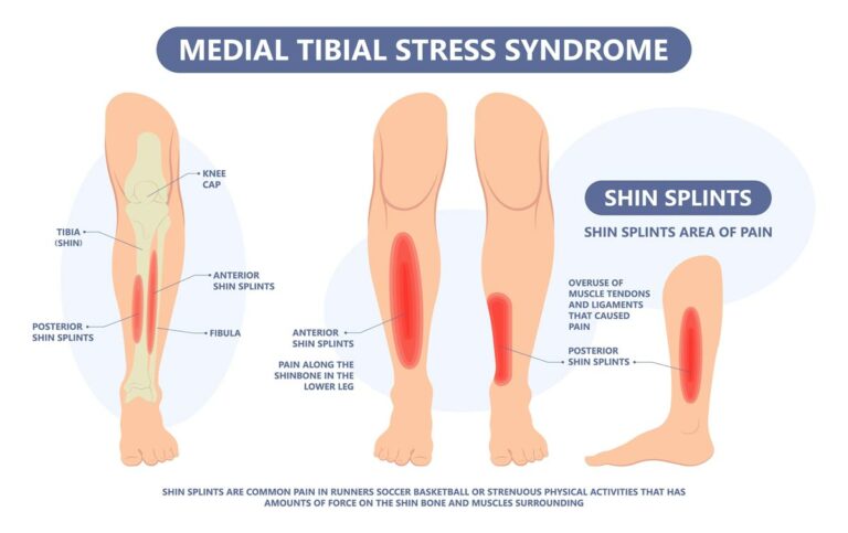 shin splints explained in an illustration
